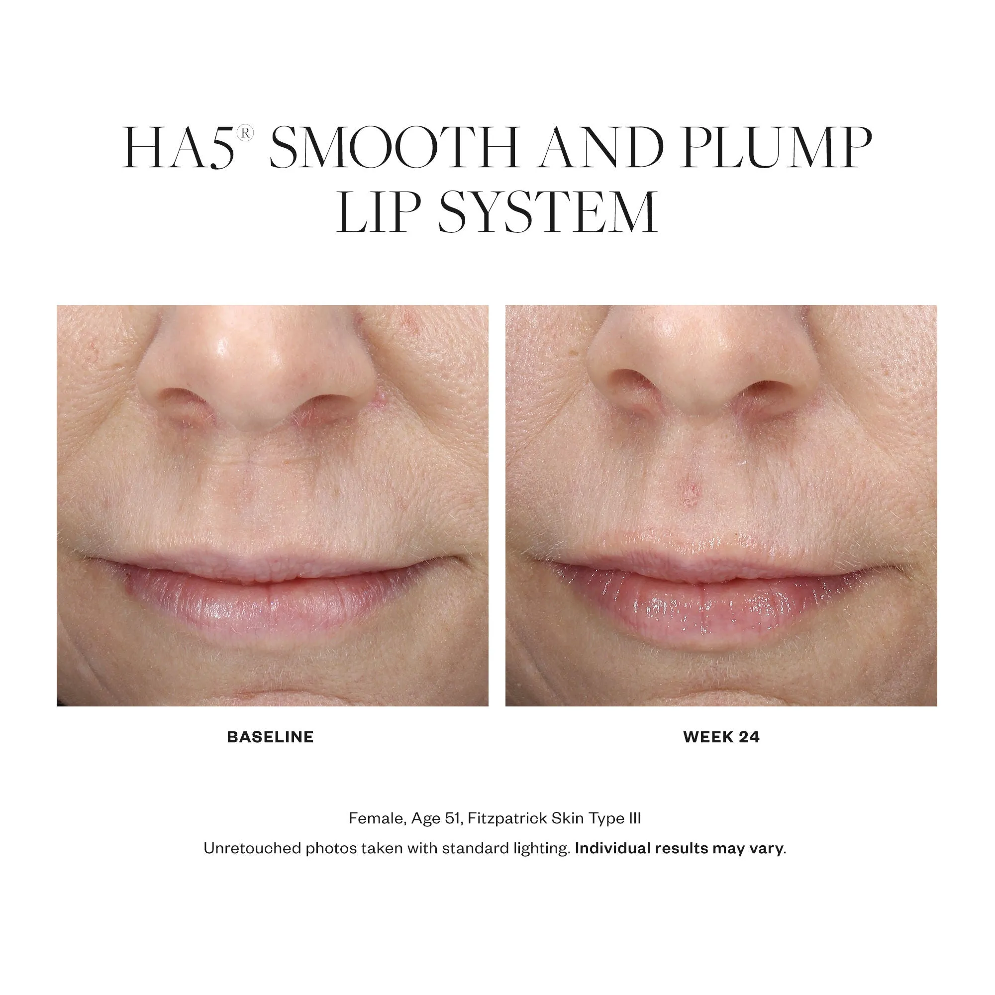 HA5 Smooth and Plump Lip System